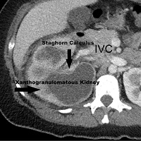 Staghorn Calculus and Xanthogranulomatous