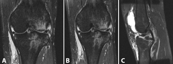 (A) and (B) demonstrate coronal views of the affected knee. Marrow contusions are apparent as well as the injuries to the medial and lateral menisci. (C) Sagittal section of the knee demonstrating the fracture to the tibial eminence and the intact PCL.