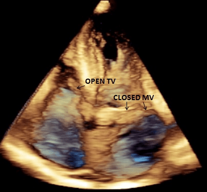 Carcinoid Heart Disease: Classical Echocardiographic Features