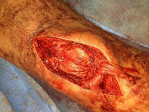 Intraoperative photograph showing the repair to the patellar tendon as described.