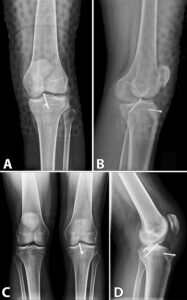 Radiographs during the post-operative follow-up. 