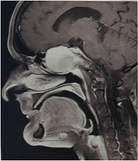 Post-Radiation Sphenoidal Mucocele in a Patient