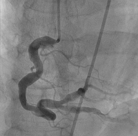 Primary Angioplasty Using a Renal Stent in a Severly Ectactic and Occluded Left Anterior Descending Coronary Artery