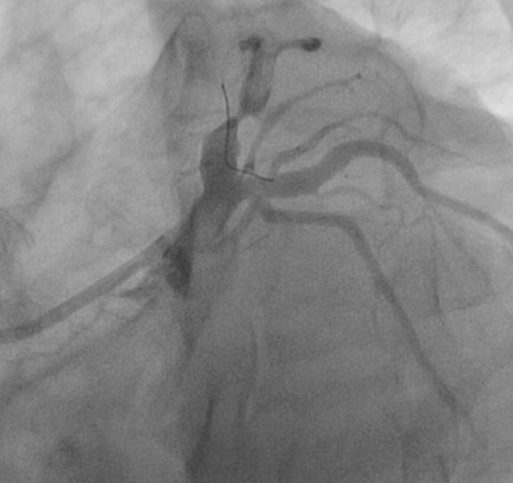 Caudal view after the wire crossed the lesion in LAD shows a heavy thrombus burden