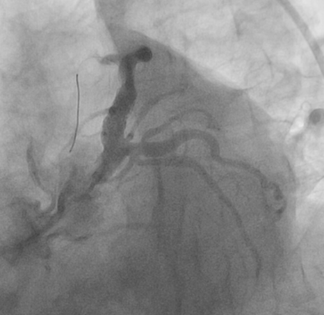 LAO caudal view after the stent is deployed