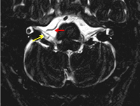 Neurovascular Conflicts of Cerebellopontine