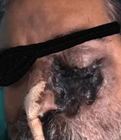 Mucormycosis A Fungal Rarity Mangling