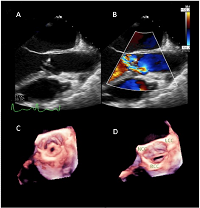 Dynamic Shape Change of an Aortic Valve Cusp Perforation on 3D Transesophageal Echocardiogram