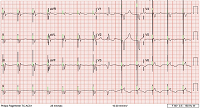 Advanced Heart Failure Exacerbated by Discreet Left Ventricular Lead Non-Capture
