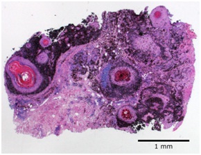 Squamous Melanocytic Tumour at an Unusual Site