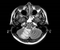 Vertebral Artery Dissection Mimicking Migraine: A Case Report
