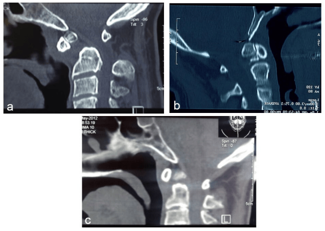 Three Different Cases with os Odontoideum of Othotopic Type