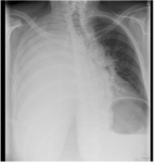 Chest X-ray demonstrates pleural effusion.