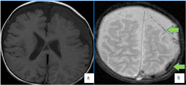 Weighted Images Demonstrate Bi-Frontal Chronic Subdural Fluid Collections