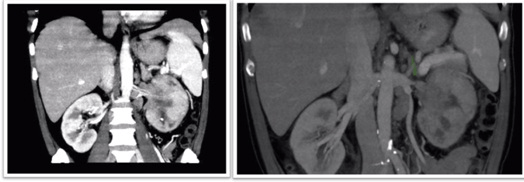 Abdominal and Pelvic CT (Coronal Reconstruction). Tumor Lesion