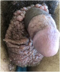 Microcystic Scrotal Lymphangioma