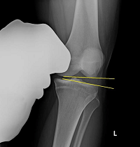 Functional Movement Analysis in the Differential Diagnosis of a Patient with a Posterolateral Corner Knee Injury