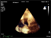 Saddle Thrombus seen on Transthoracic Echo: A Rare Feature in Pulmonary Embolism