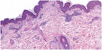 Cutaneous Polyarteritis Nodosa in Adult Patient