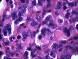 Pleomorphic Giant Cell Carcinoma of Urinary Bladder