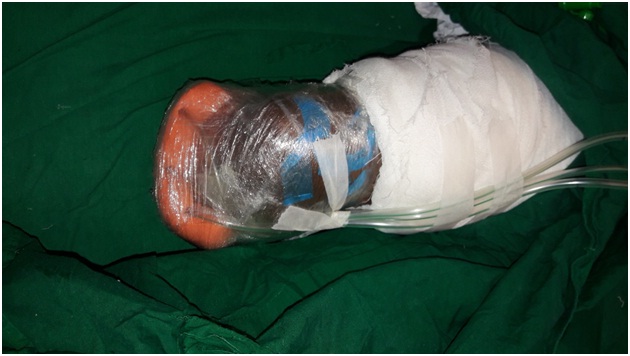 The Role of Negative Pressure Wound Therapy with Instillation