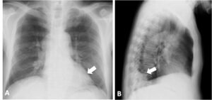 Chest X-Ray Demonstrated the Mass as Large as 4 cm at the Left Lower Lung Field (Fig. 2, Arrow).