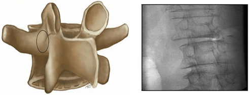 Diagram and X-ray with an Orthograde View Through the Ipsilateral Pedicle (So-called en Face or Pedicle View Image)