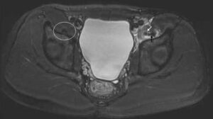 STIR axal hips MRI at level of acetabulums