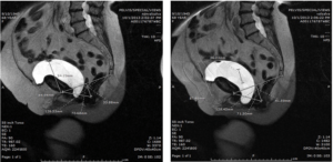 Sample of Two Pre-operative Images from One Patient (T2-weighted Image, Sagittal Section) in the First Upright MRI Series