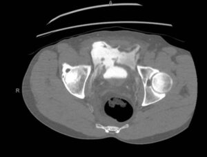 Coronal View of the Bladder