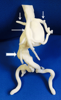3D Printed Models of Complex Anatomy in Cardiovascular Disease