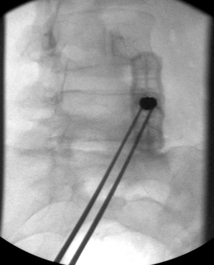 Trajectory view, 11G needle on the dorsal aspect of the pedicle