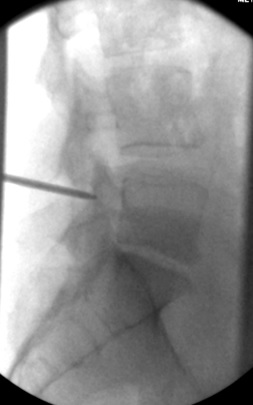 Lateral view, 11G needle engaging dorsal aspect of pedicle