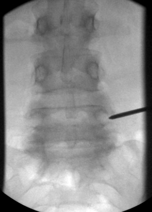 AP view, 11 G needle engaged in the mid-pedicle, note clear of medial wall of pedicle
