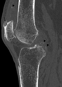 Gouty Arthritis of the Axial Skeleton: A Case Report