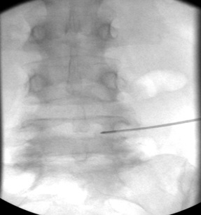 AP view, 17G radiofrequency electrode within vertebral body