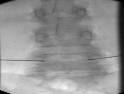 AP view, after repeating procedure on the left side to place 17 G radiofrequncy electrodes within vertebral body