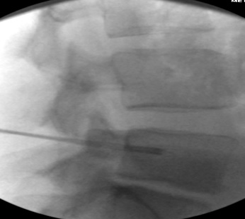 Lateral view, 17G radiofrequency electrodes in position for bipolar lesion within the vertebral body, note that the tines are deployed