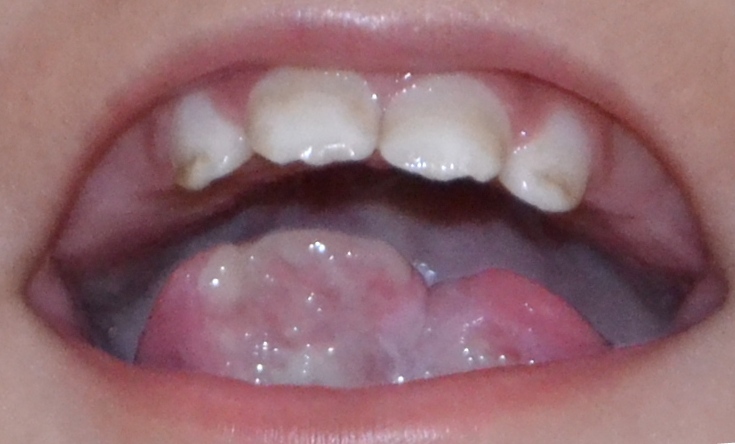 Oral Self-Injury: Report of a Case with Review of Literature