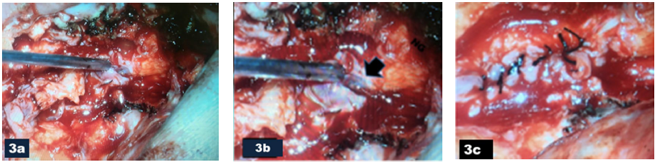 An Intraoperative Photograph Showing a Breach is Demonstrated at the Bottom