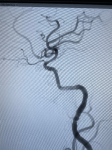 Complete Occlusion of Carotid-cavernous after the Aneurysm Coiling