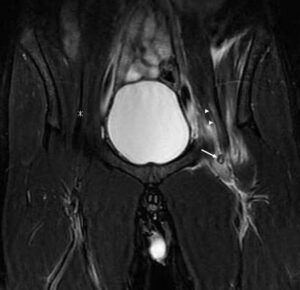 STIR coronal hips MRI at level of pubic symphysis