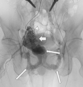 Angiography of Pelvic Arteriovenous Malformation