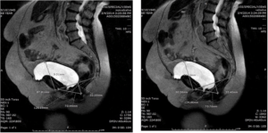 Sample of Two Post-operative T2-Weighted MRI Images