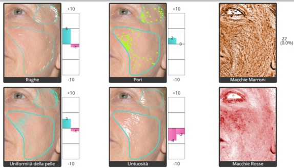 Example of the Assessment of Skin Parameters Using Skin Care Software (3D Photosystem LiveViz; (QuantifiCare Inc., CA, USA)