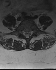 Axial T2 weighted image at L5