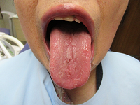 Using PF-MOUTH GELTM for Sore or Painful Tongue Improved