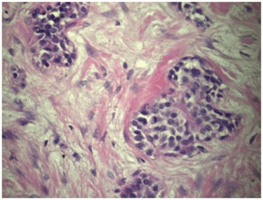 Nested Type Urothelial Carcinoma