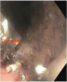 Overstitch used to Secure the Esophageal Stent
