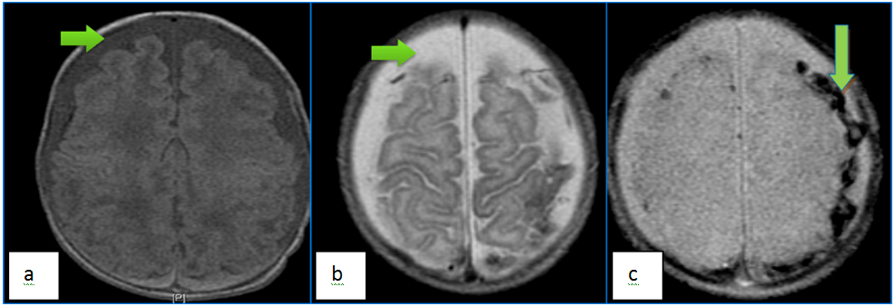 Weighted Demonstrates Bifrontal Chronic Subdural